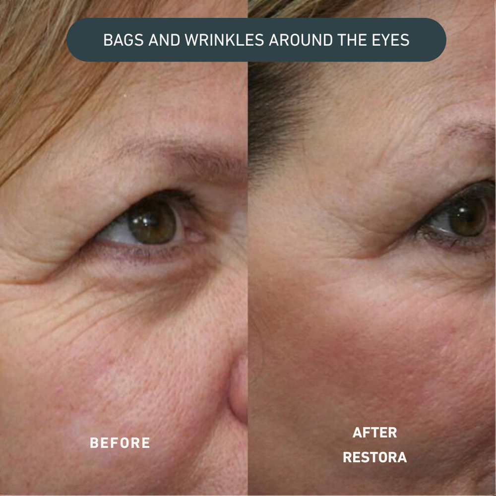 Lift Pro Micro-Infusion