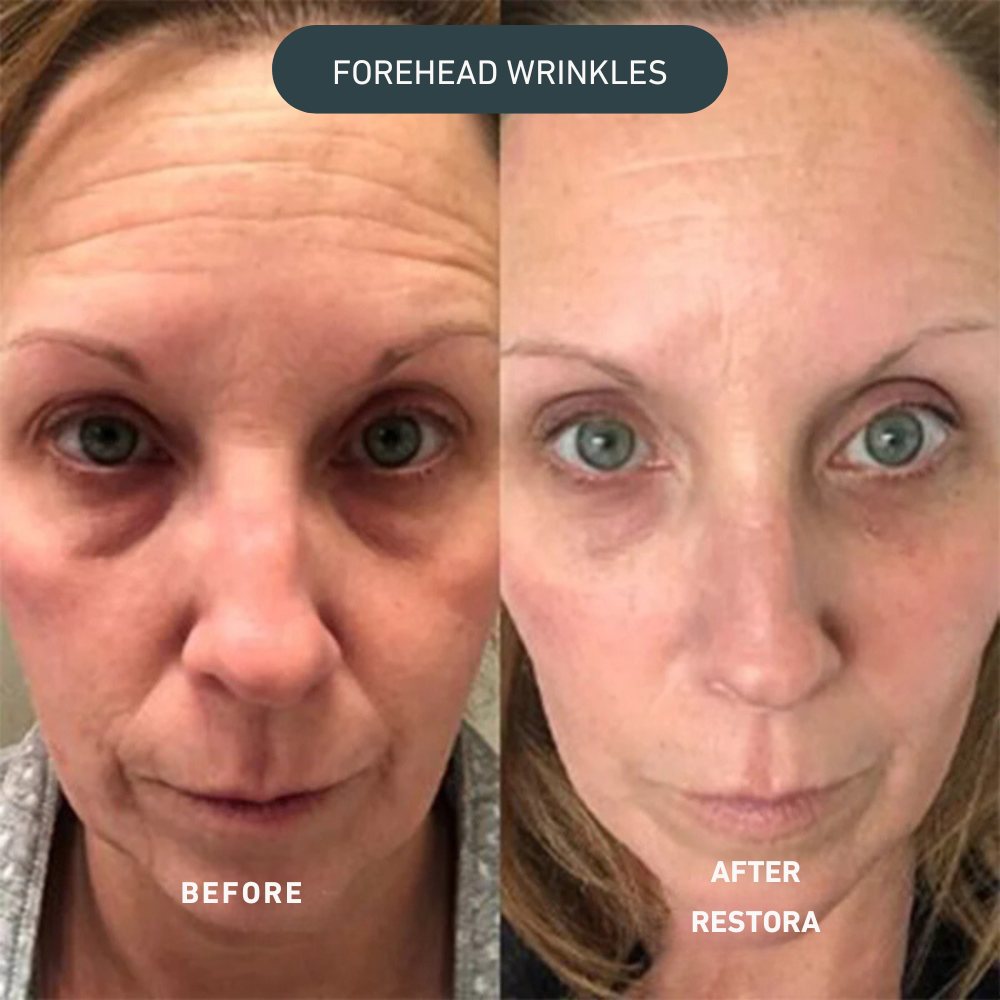 Lift Pro Micro-Infusion