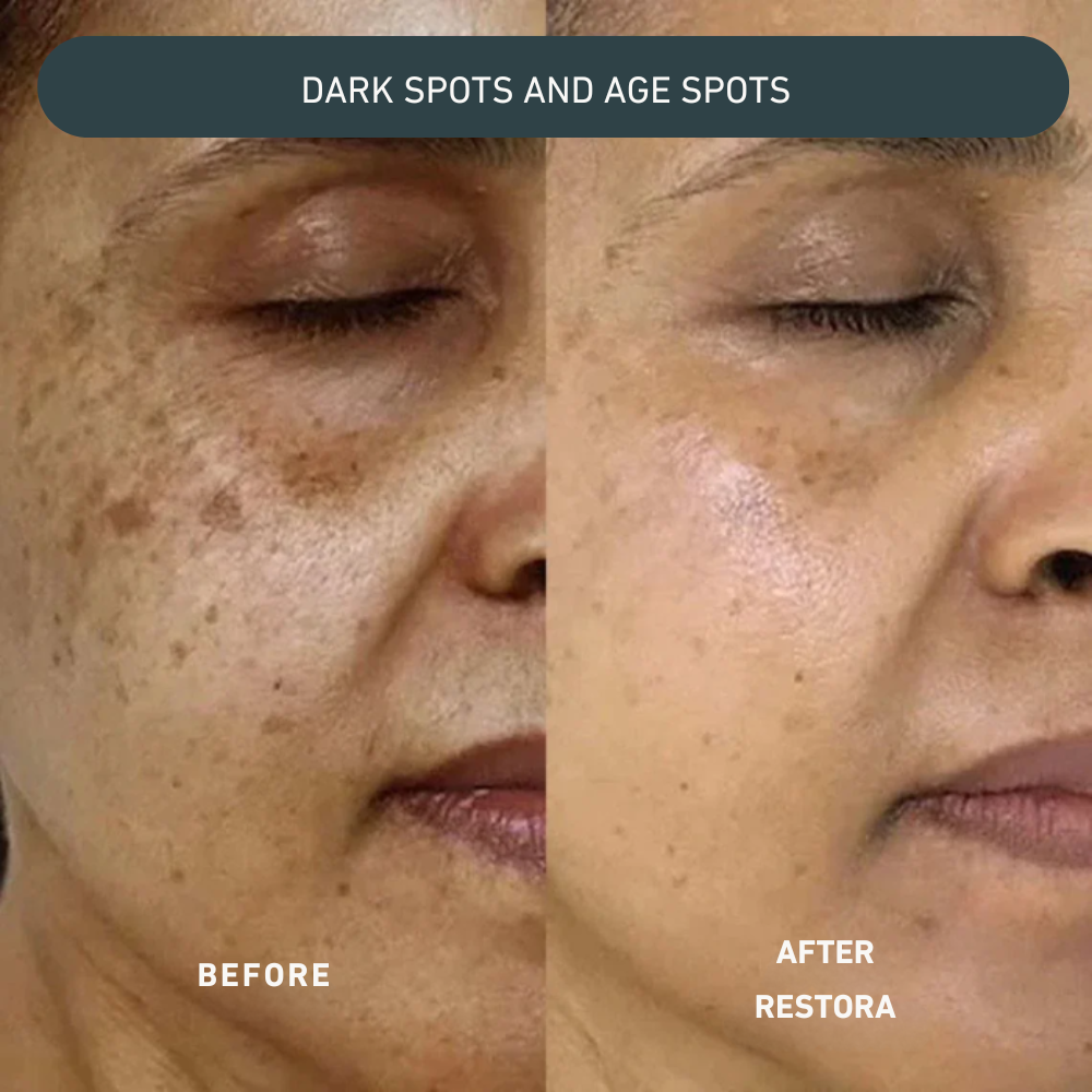 Lift Pro Micro-Infusion