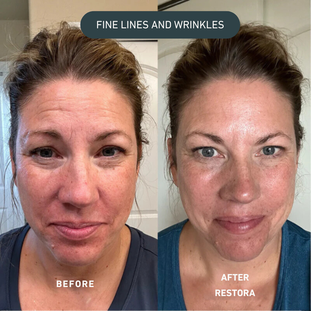 Lift Pro Micro-Infusion