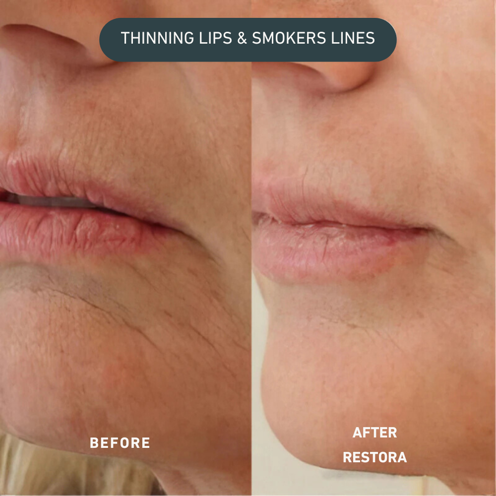 Lift Pro Micro-Infusion