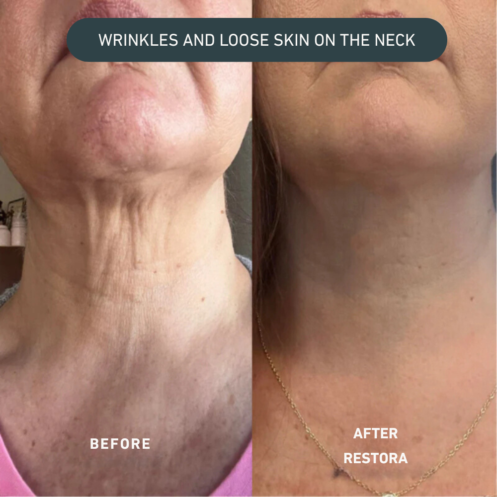 Lift Pro Micro-Infusion